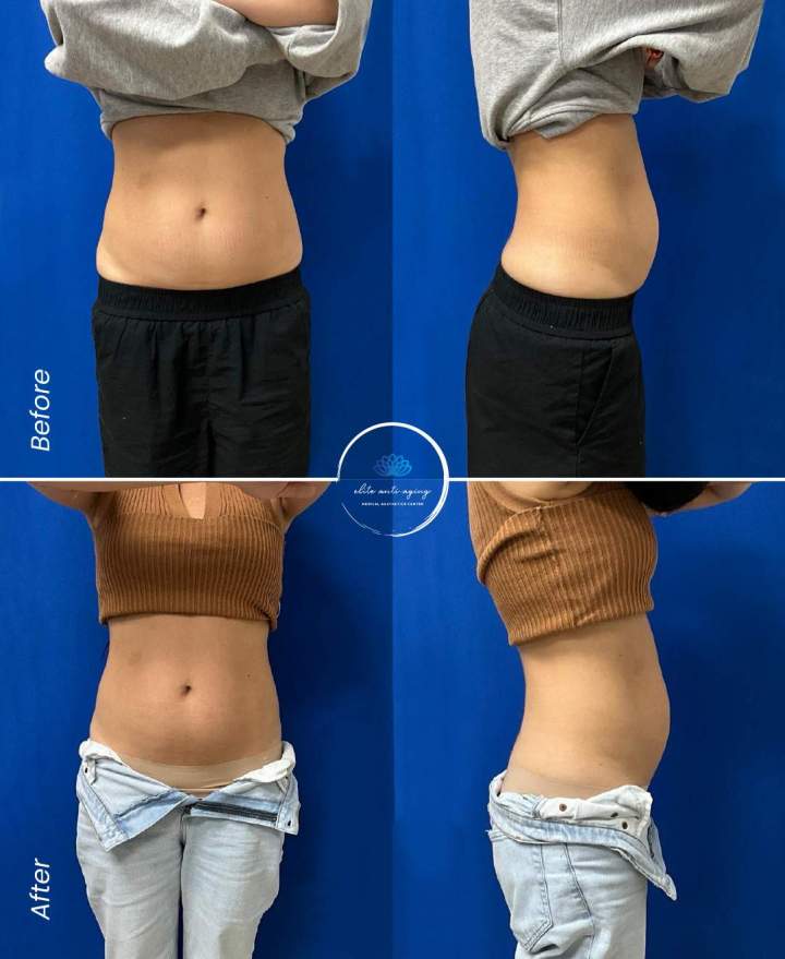 Elite Sculpt-RF Body EMS+RF Body Contour