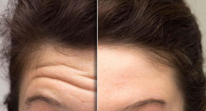 Botox Treatments Pembroke Pines
